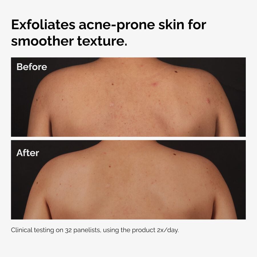 the-body-care-collection-n3 ord-salicylic-acid-body-serum-before-after-graphic-NA.jpg